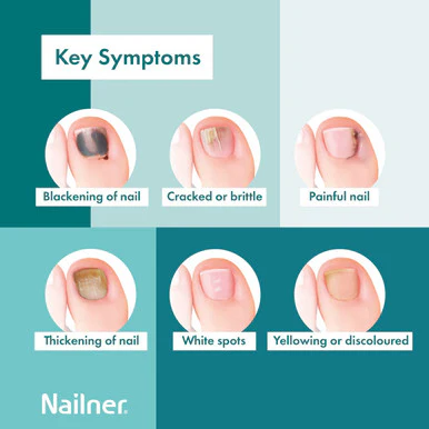 Nailner 2-in-1 Fungal Nail Treatment Brush 5ml - Image 3