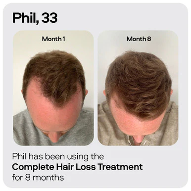 Sons Minoxidil 5% Spray 1 Month - Image 3